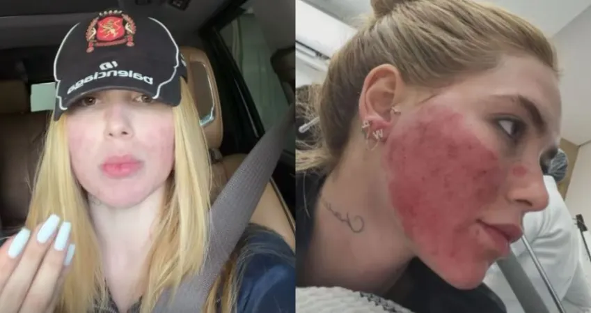 Virginia se arrepende de procedimento no rosto: “Tinha necessidade?”